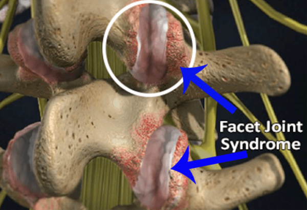 Spinal Facet Joints And Your Neck Pain